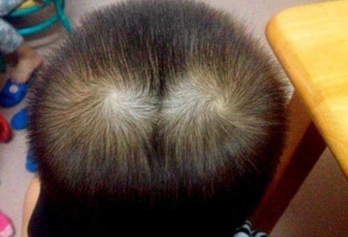 为啥有的孩子头上有2个“旋”?关于头旋的奥秘,家长要了解 为啥有的孩子头上有2个“旋”?关于头旋的奥秘,家长要了解