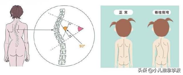 孩子高低肩驼背?小心脊柱侧弯!小儿推拿李波呼吁关爱儿童脊柱!