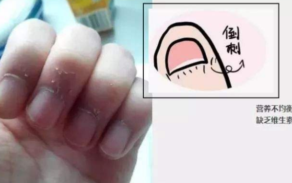 孩子那么小，为什么还会长倒刺？这是为啥呢？