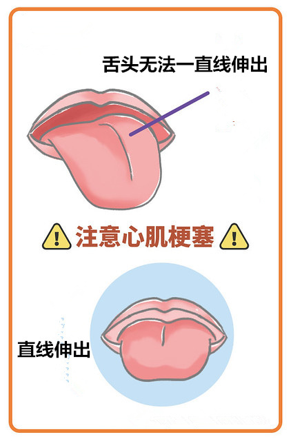 舌头看出胃癌,心脑血管信号!3种最危险舌头征兆