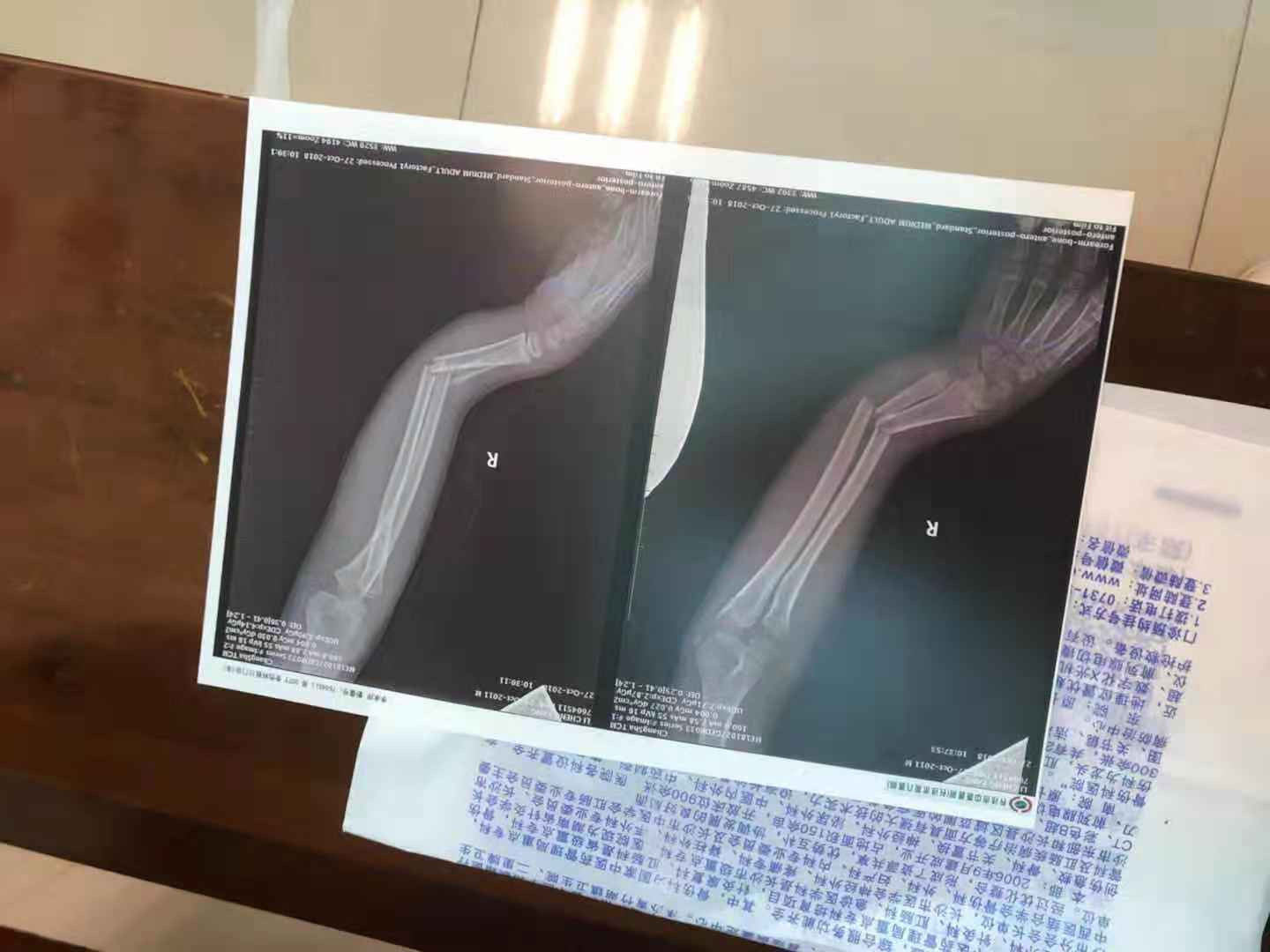 长沙男童手臂骨折扭成"麻花",中医手法整复几分钟搞定(图)