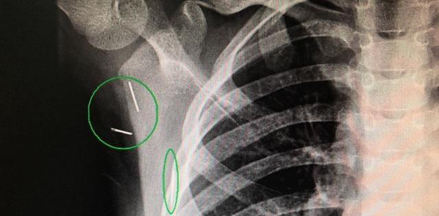 7岁孩童咳嗽久不好,妈妈带到医院拍片,罪魁祸