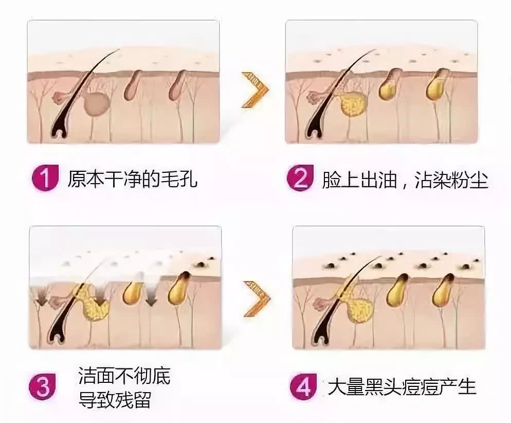 皮肤爆痘,黑头,毛孔粗大.