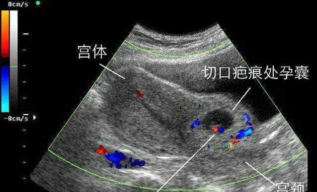 胚胎长在刀疤上,疤痕妊娠,我不堪回首的经历