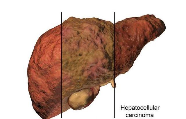 有肝炎,转氨酶越高离肝癌越近,常饮1种水,