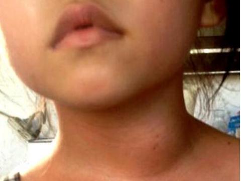 九岁宝宝脖子隆起肿块被诊甲状腺癌,只因家长忽略耽误治疗
