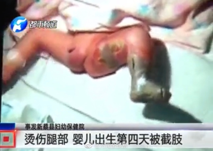 刚出生4天的婴儿在医院严重烫伤,惨遭截肢 ![泪][伤心