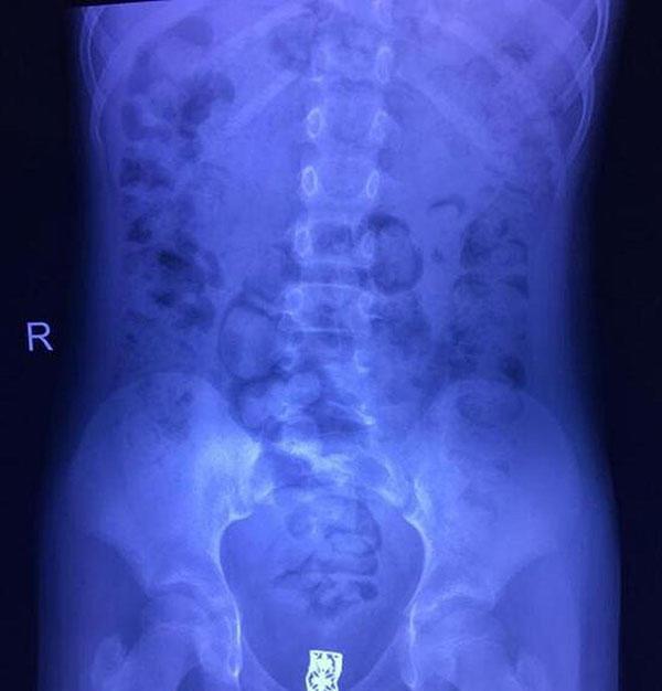 6岁女孩总是喊肚子痛,身体还发出臭味,检查后