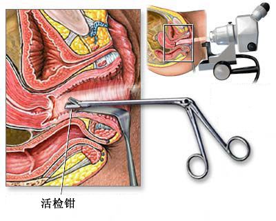 宫颈癌筛查和活检是一个意思吗?