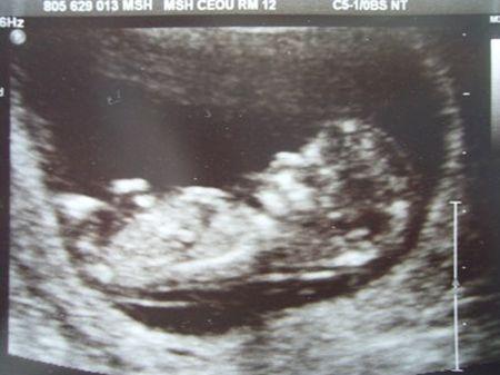 这种唐筛准确率堪比无创DNA,价格却不到其十