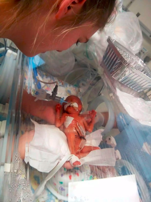 年轻产妇怀孕23周就生下女儿,宝宝身体发红像外星人