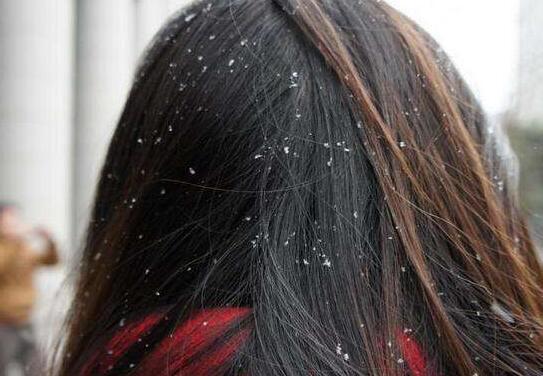 头皮发痒, 头屑又多, 这是什么情况? 可能是这几