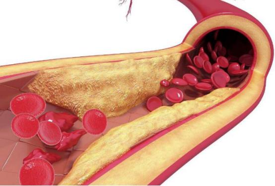 酯高加速动脉硬化,3个方法一步步降甘油三酯,