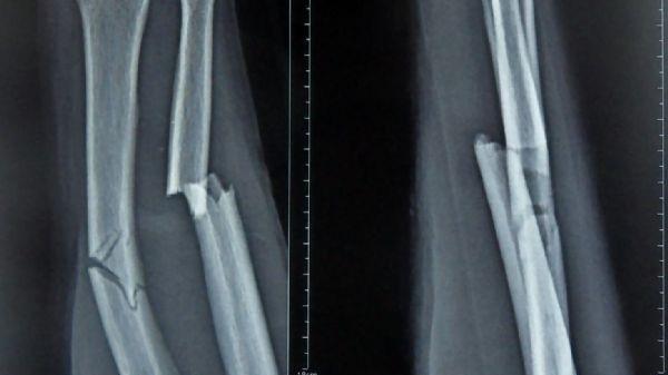 骨折吃三七管用吗? 骨折后怎样恢复得快?