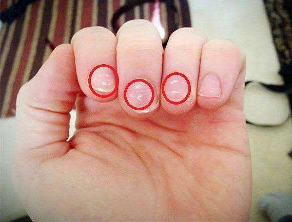 宝宝指甲白点,医生检查并不是蛔虫,竟是因为缺