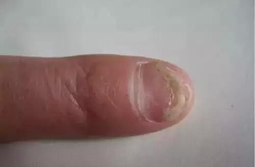 灰指甲会感有疼痛感吗? 哪些因素会引起灰指甲