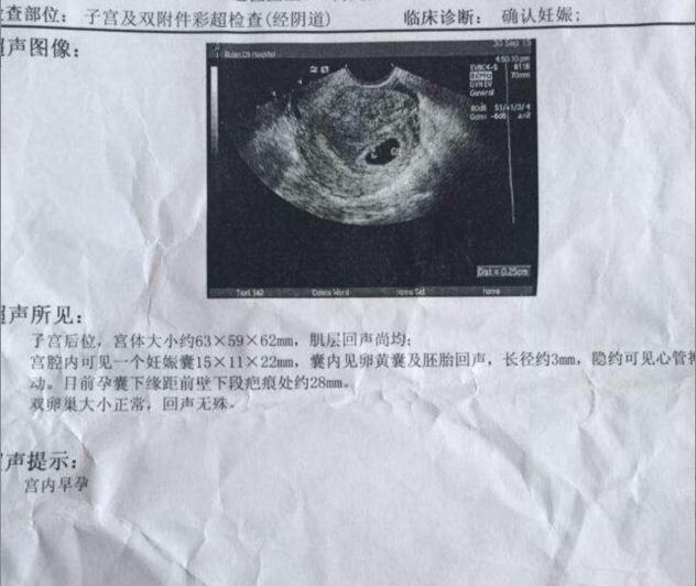 孕囊看男女!据说很准!教你怎么看!