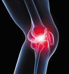 膝盖骨刺的不用再担心了,这个外用的神奇小偏