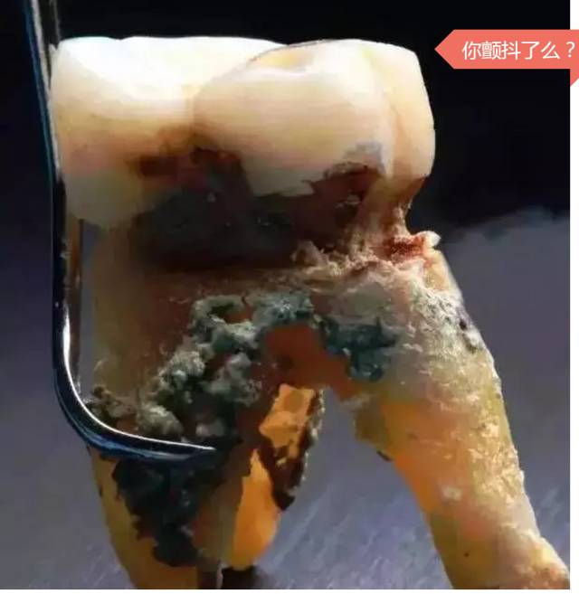 洗牙不可怕，可怕的是你总是不去洗牙!