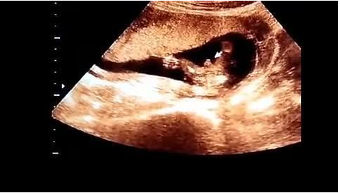 四个月去医院做四维彩超,医生的一个小小暗示