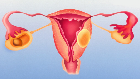 活检CIN病变可逆转,多吃三类食物激活免疫系统