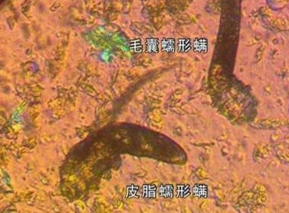 脸上有3个变化过程, 如果挤出白色条状栓物, 说