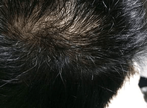 头上出现螨虫时, 4个症状会很明显, 3方法能及