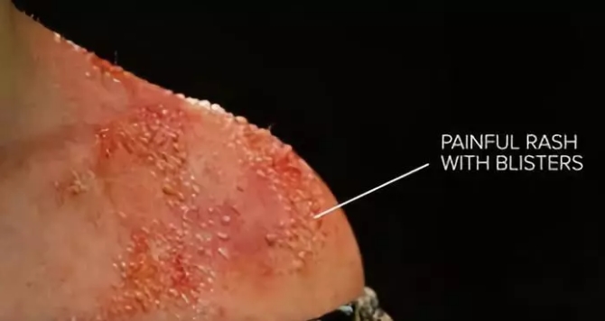 热点 | 疫苗的前世今生