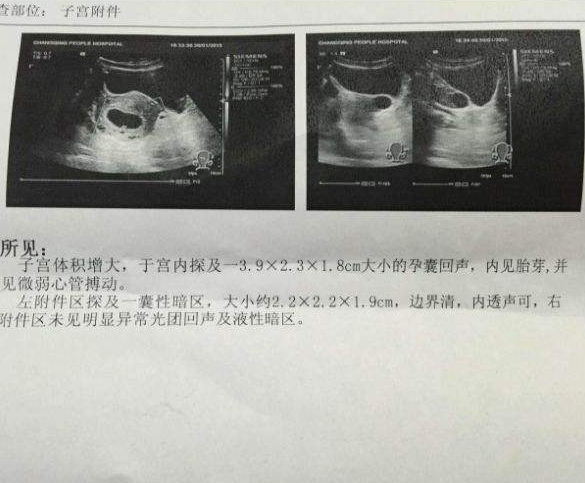 3,看孕囊的形状我们还可以通过b超单上孕囊的形状来判别胎儿的性别,有
