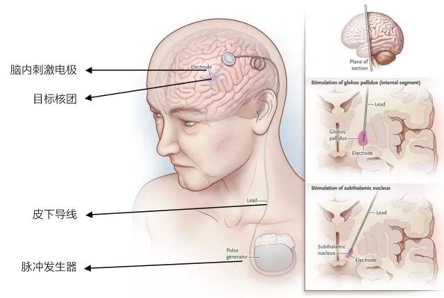 帕金森手术入医保 神经调控未来有多神奇?