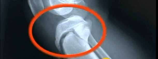 一场篮球赛差点让13岁男童停止长高