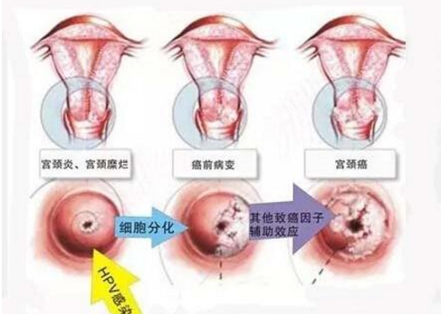 所有宫颈癌都与HPV病毒有关系，女性要如何才能防住HPV感染？