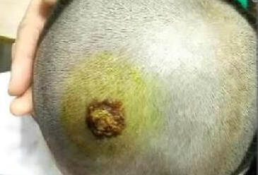 男童头上长了个红疙瘩,医院检查,医生取出来的