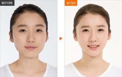 杨幂自称拔牙后方脸变成瓜子脸,拔智齿瘦脸?这