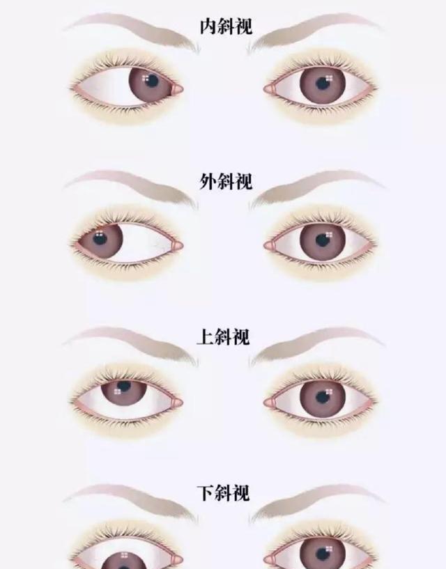 文文的孩子斜视角度超过正常范围,医生建议尽快手术.