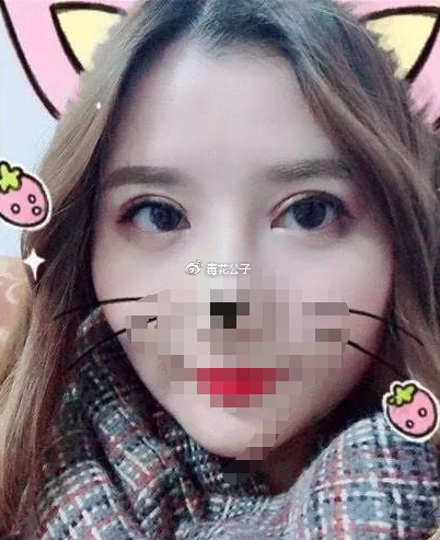 长春全切双眼皮修复手术两个月心得分享