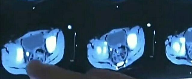 一岁多孩子莫名呕吐不止,医院检查,得知原因,宝