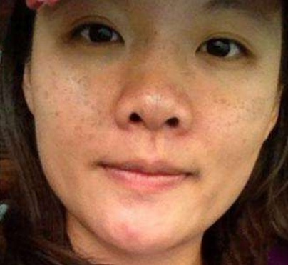 万万没想到一元的药店药膏,每天抹脸不洗,祛斑