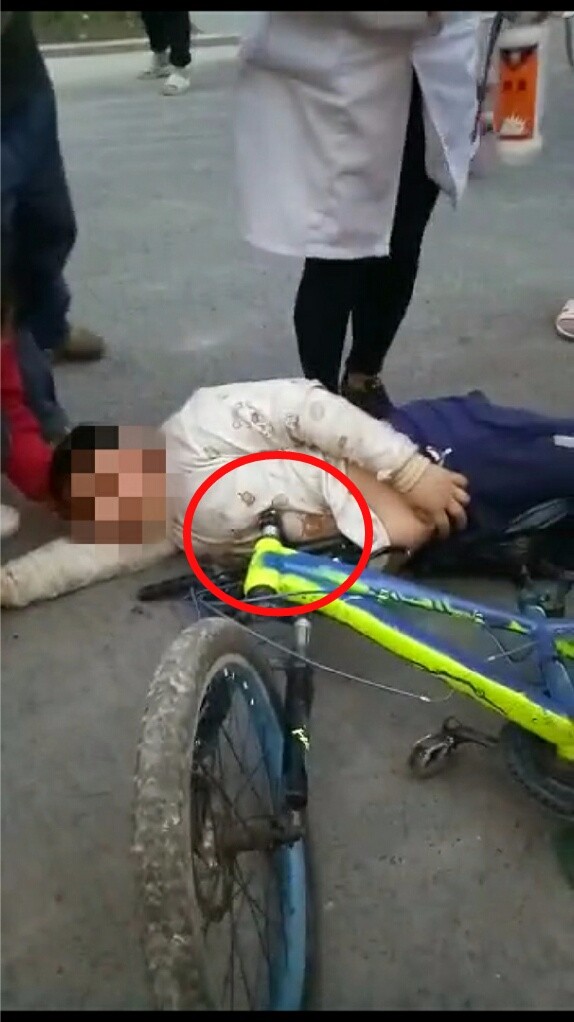 宜宾沙坪一小男孩骑自行车摔倒,车把手直接戳进肚子