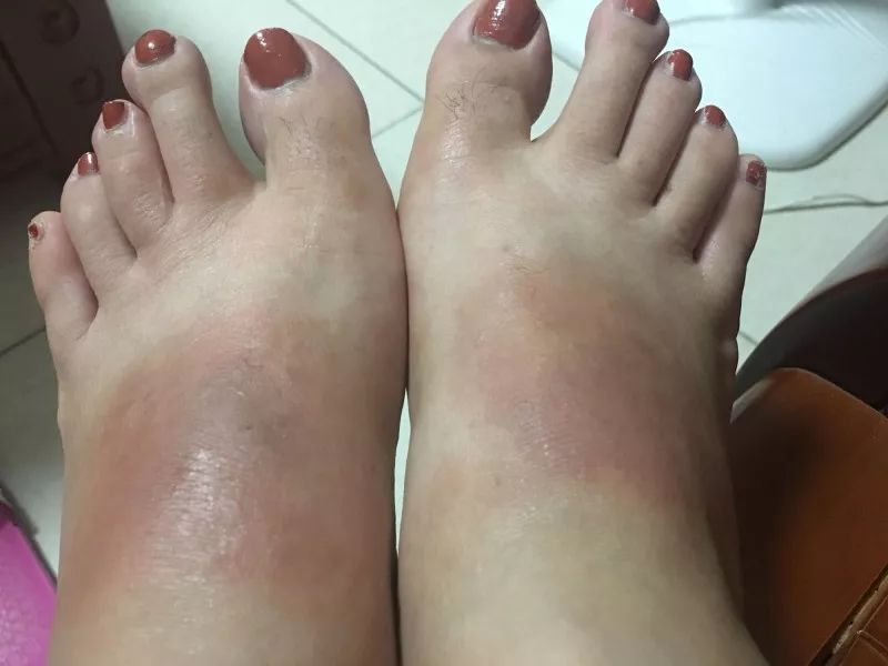 警惕！路边碰到这种小红土堆，赶紧躲远点！已有多人中毒、休克！