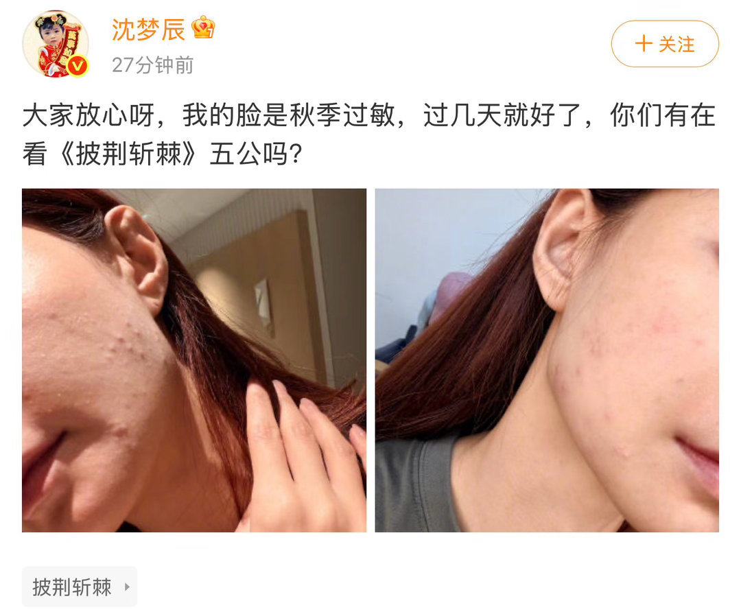 沈梦辰回应脸因秋季过敏