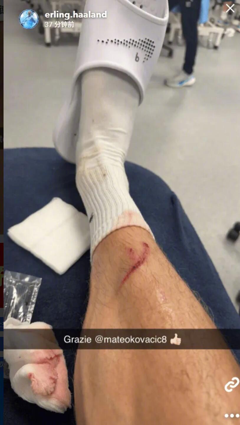 哈兰德晒训练受伤照，科瓦契奇致其小腿出血
