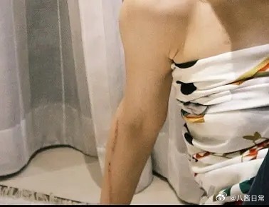 张子枫拍《我们生活在南京》手臂留十几厘米疤痕