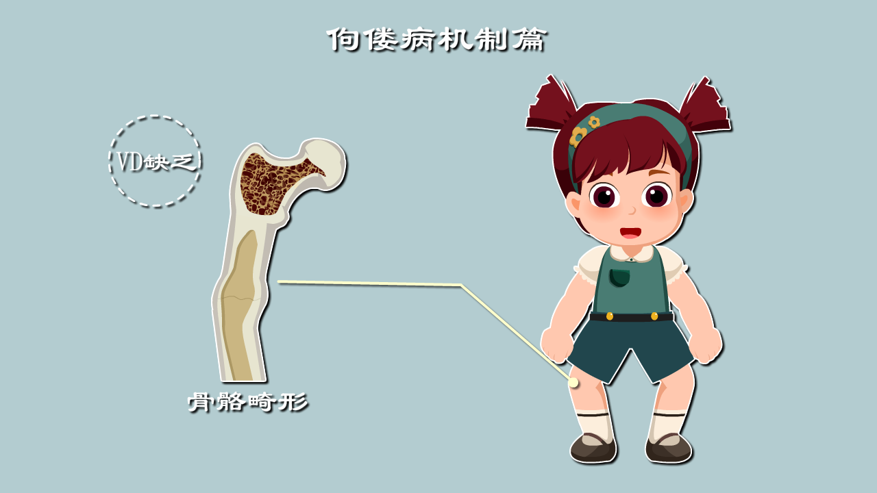 佝偻病是咋来的晒太阳能治佝偻病是真的吗五分钟科普超级赞