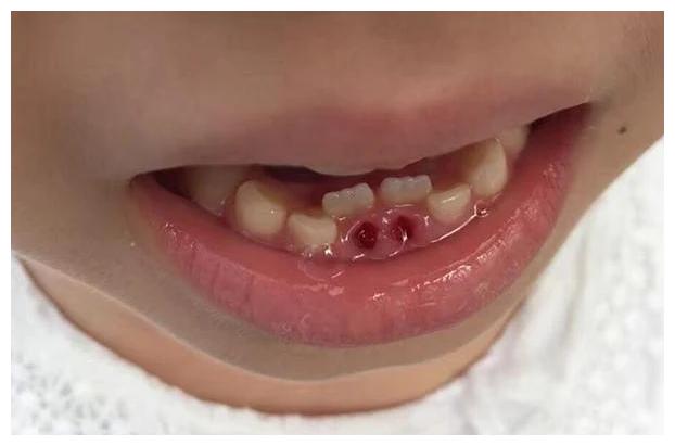 孩子的两颗乳牙终于掉了,但由于乳牙掉落太迟了,孩子的恒牙已经长歪了