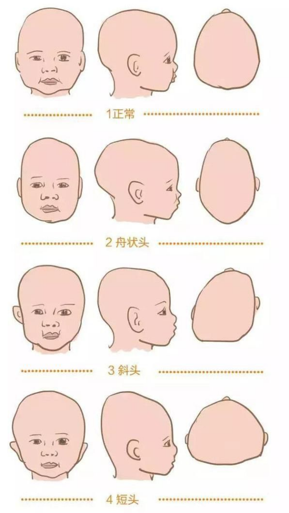 上述妈妈说自己宝宝左右头部形状相差很大的情况,其实在医学上叫做扁