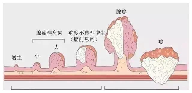 西安东大肛肠医院丨这个肠癌,几年前还是一枚小息肉!