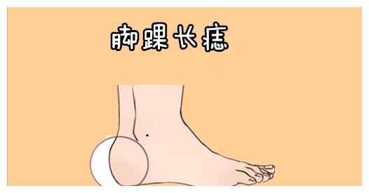 脚踝长痣在相学当中,若是脚踝的位置处长有恶痣,则属于典型的麻烦痣