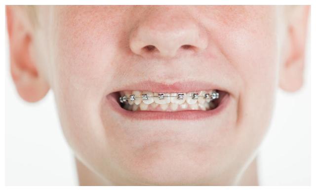 家长牢记:儿童做牙齿矫正三个最佳时间,矫治越早干预越好|牙齿|矫治器