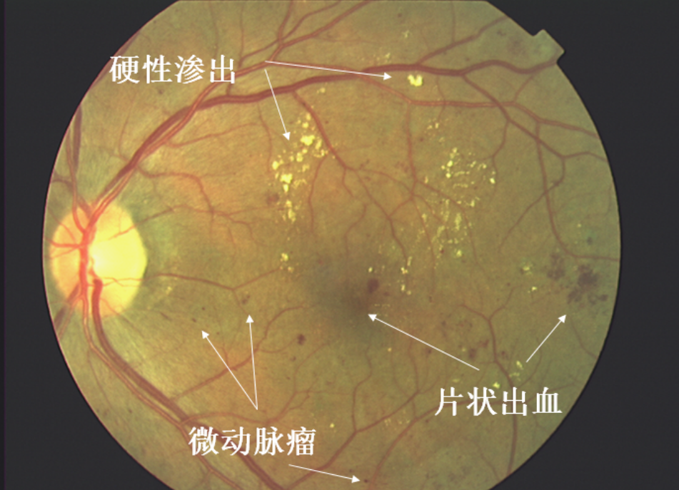 爱眼底|传闻中的视觉杀手——糖尿病视网膜病变!